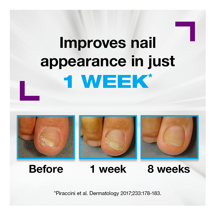Emtrix® Fungal Nail Treatment - Image 3